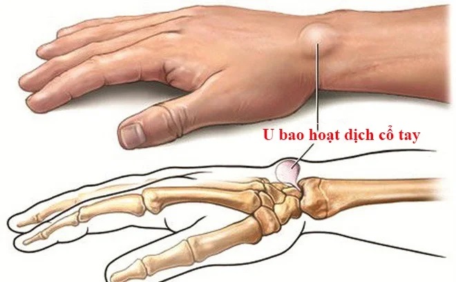 Viêm bao hoạt dịch ngón chân cái: Nguyên nhân và triệu chứng